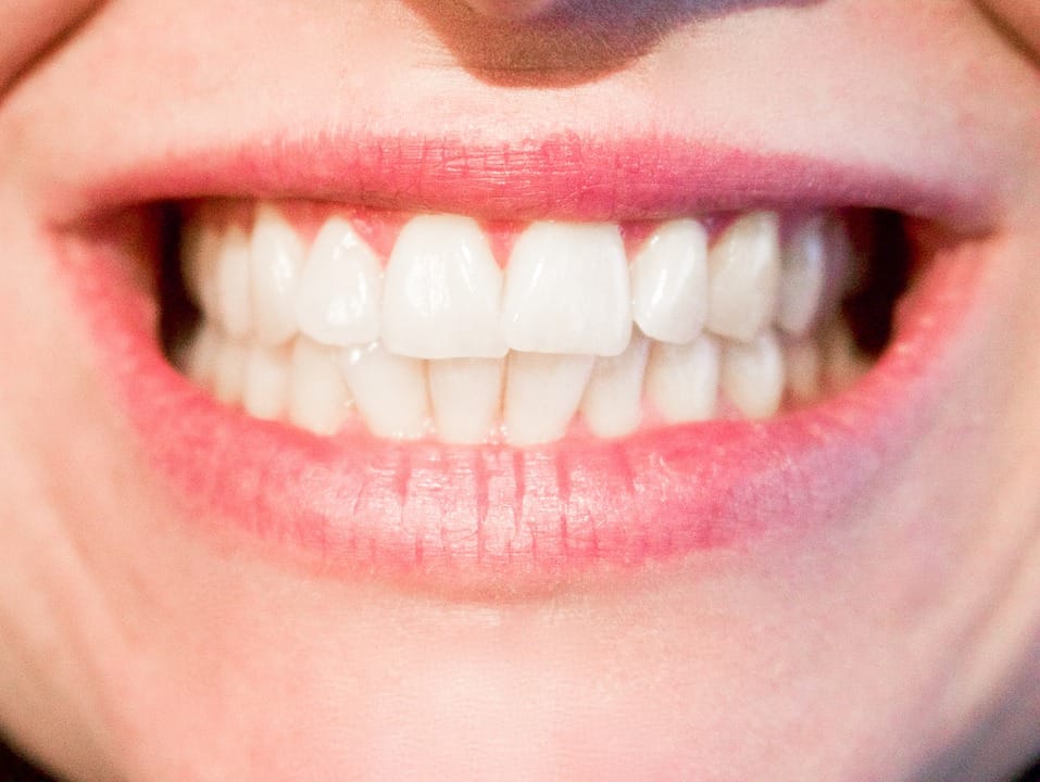 whitening teeth